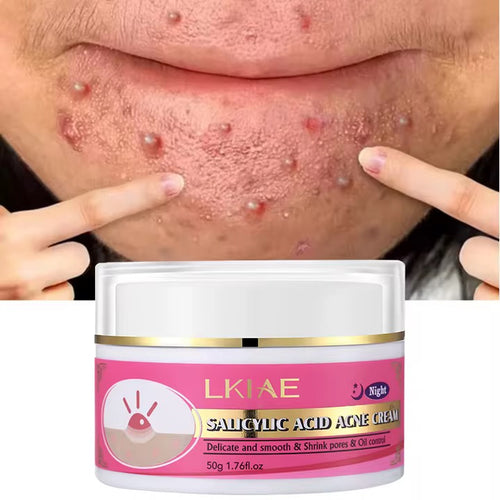 crème de visage anti-acné