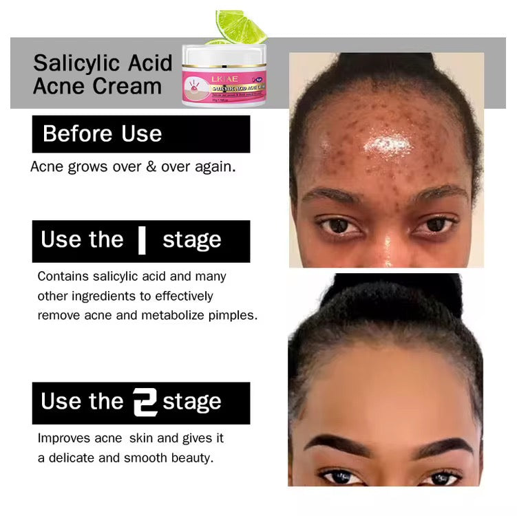 crème de visage anti-acné