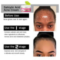 crème de visage anti-acné